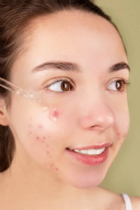 acne skin